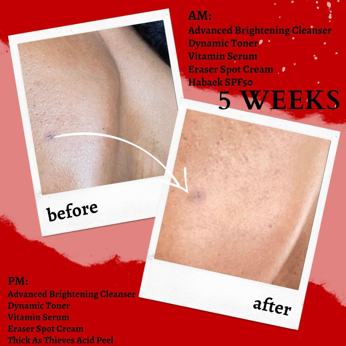 Spot corrector cream bottle in a before-and-after collage marked 5 WEEKS