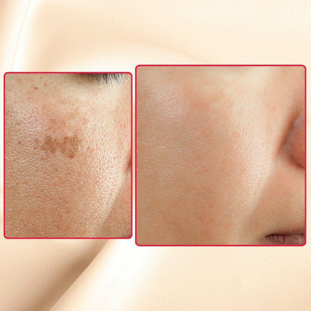 Dark spot corrector cream results on skin close-ups, before and after views