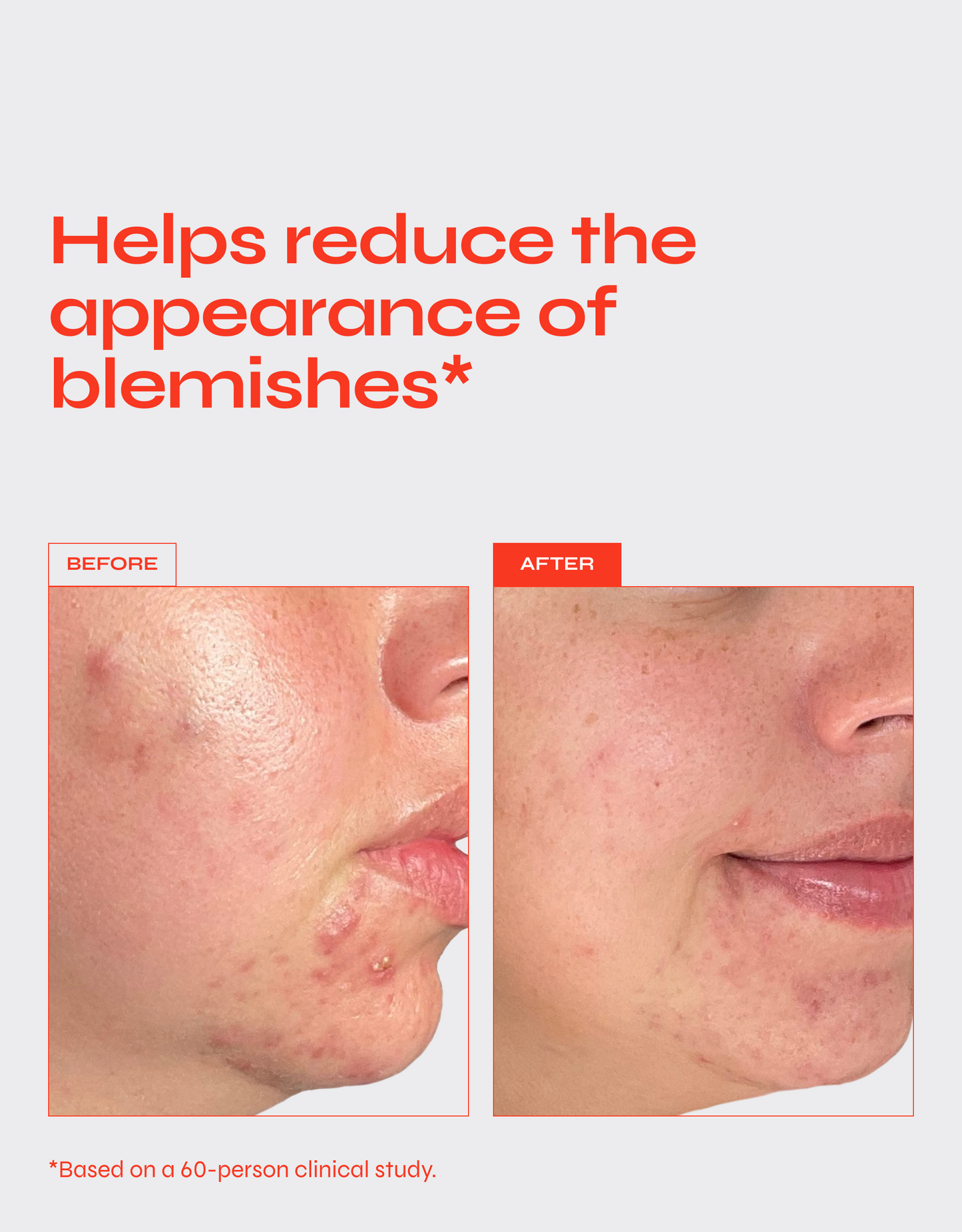 Ultimate Pimple Eraser: All-Angle Acne Solution Cream - Renee Lane Company