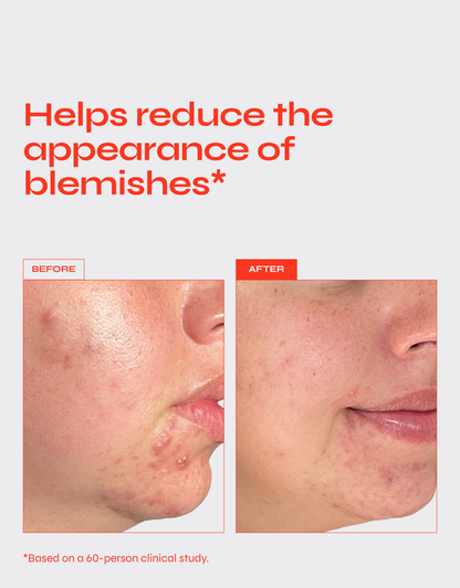 Ultimate Pimple Eraser: All-Angle Acne Solution Cream - Renee Lane Company