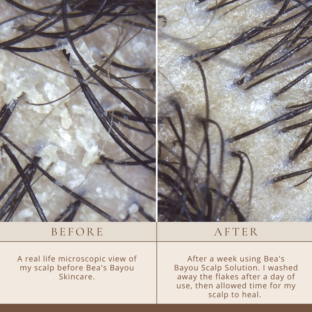 YeastDefense™️ Seborrheic Scalp Solution Double Bundle - Renee Lane Company