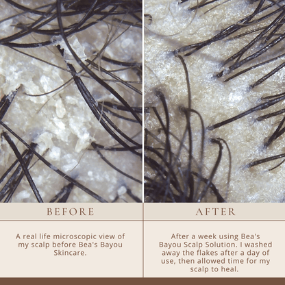 YeastDefense™️ Seborrheic Scalp Solution Double Bundle - Renee Lane Company
