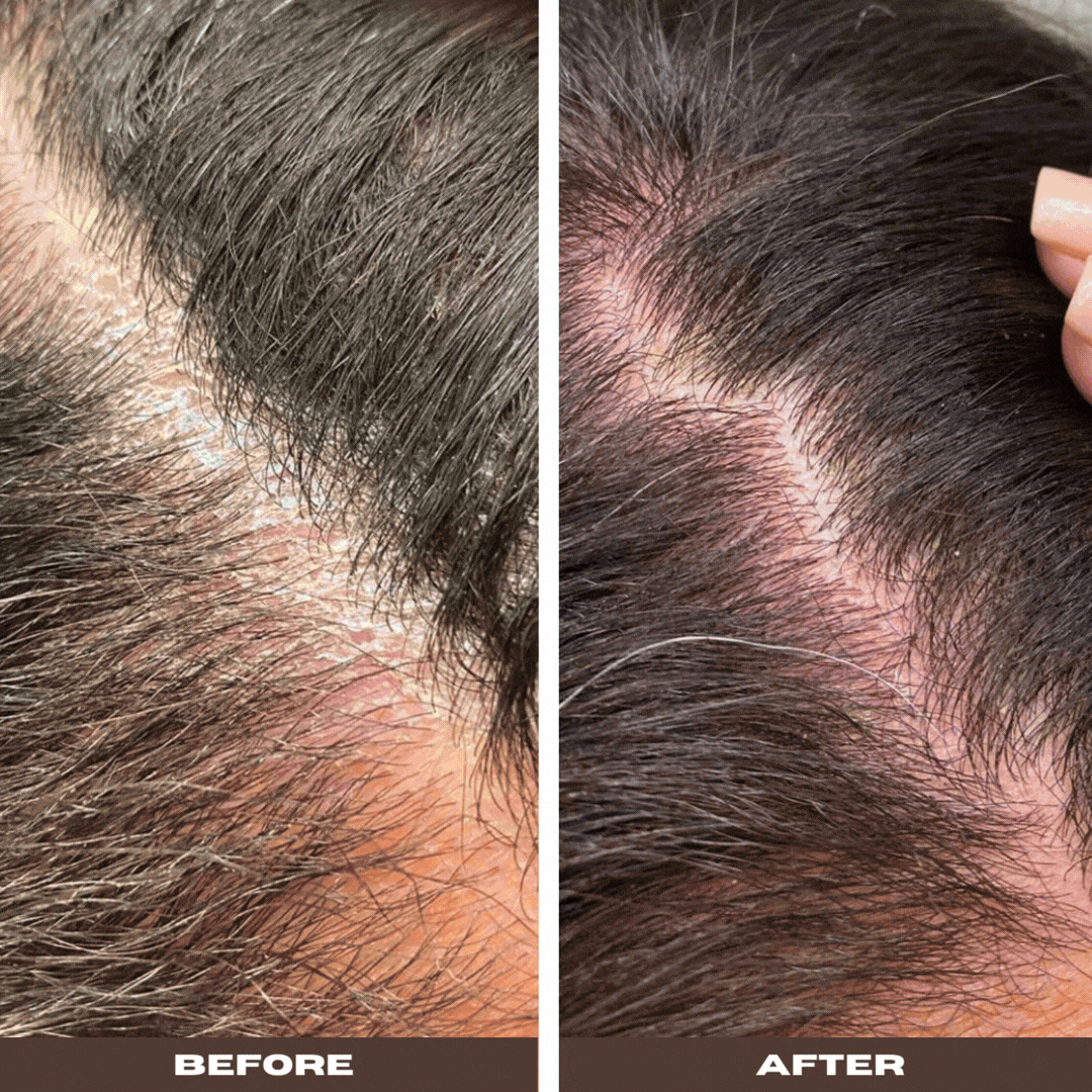 YeastDefense®️ Seborrheic Scalp Solution | Herbal Leave-in - Renee Lane Company