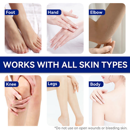 Urea cream shown for feet and hands; infographic with hand and foot application