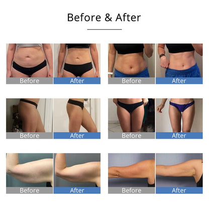 Shape Tactics 5-in-1 Ultrasonic Cavitation RF Vacuum System