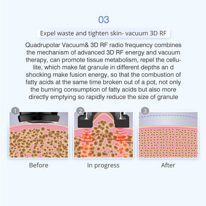Shape Tactics 5-in-1 Unoisetion Ultrasonic RF Cavitation System