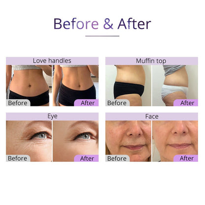 Shape Tactics 5-in-1 Cavitation Vacuum RF Body Contouring System