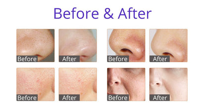 Shape Tactics HydroGlow Pro 6-in-1 Facial Rejuvenation System